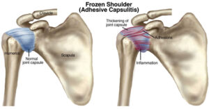 Graphic showing shoulder bones