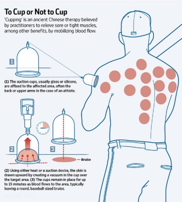 Graphic showing the cupping method
