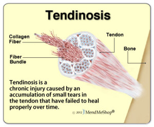 Graphic illustrating tendinosis