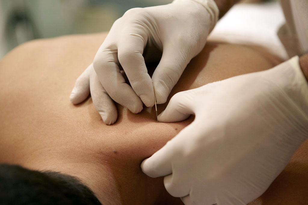 Trigger Point Dry Needling
