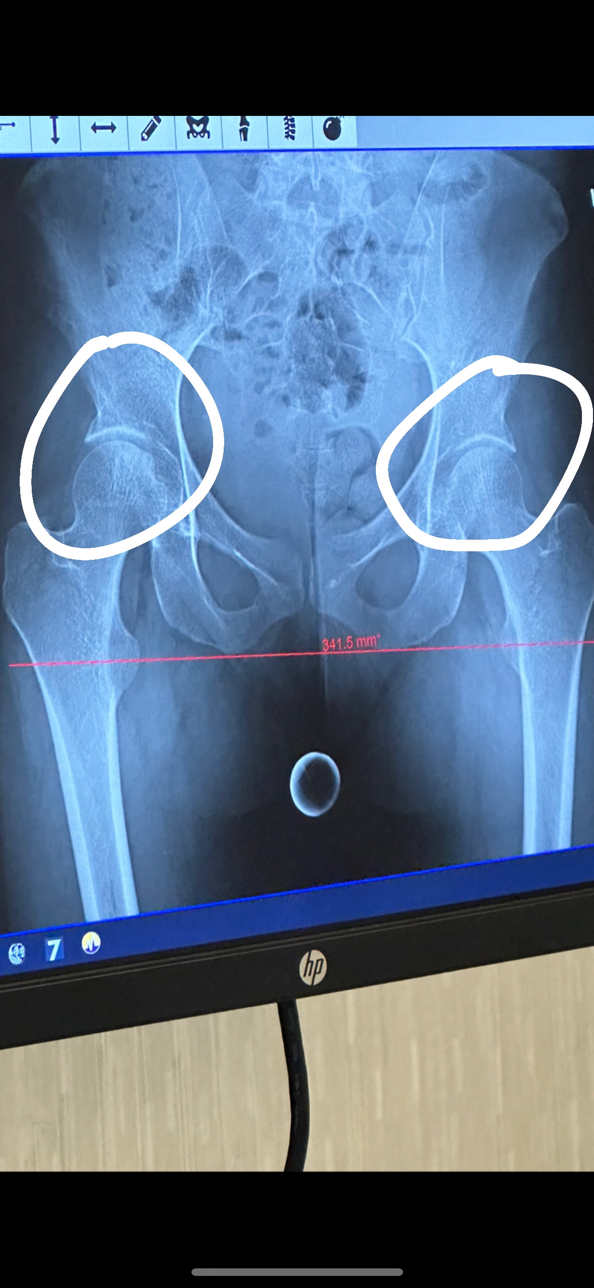 Hip Impingement