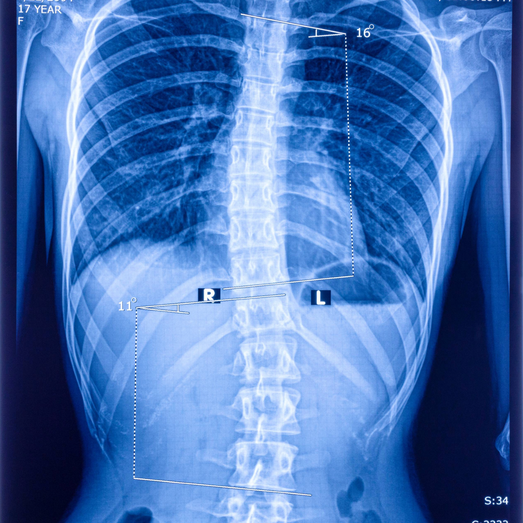 Scoliosis X-Ray
