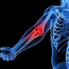 Image of an enflamed elbow